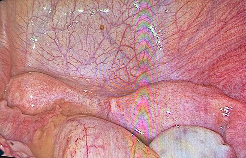 You are currently viewing Έφηβη με εικόνα περιτονίτιδας σε έδαφος διδελφούς μήτρας με απόφραξη ημικόλπου και σύστοιχης αγενεσίας νεφρού